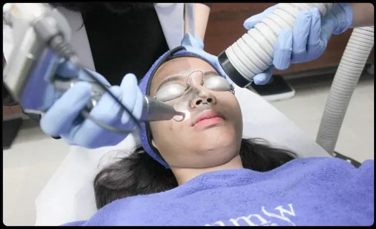 Hollywood Peel Laser