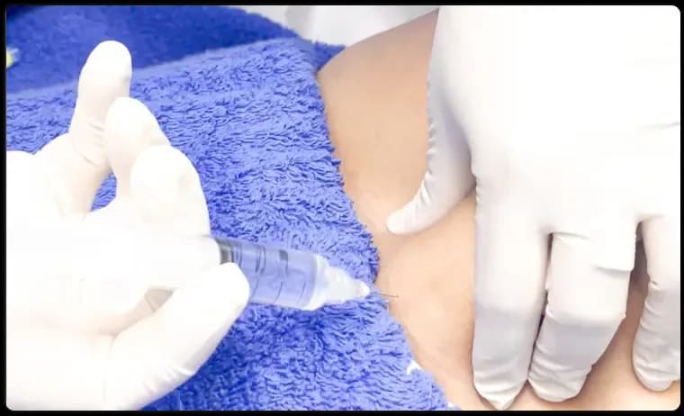 Meso Lipolysis Injection